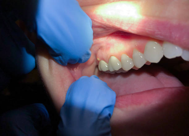 Best Emergency Root Canal Treatment in Wallington, NJ